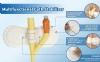 Disposable Adhesive Urethral Catheter Fixation Device Fixation Tube Holder Urethral Catheter Fixation Device